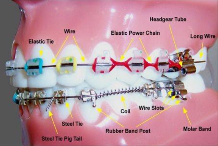 Thicker Wire Braces - Fine Orthodontics
